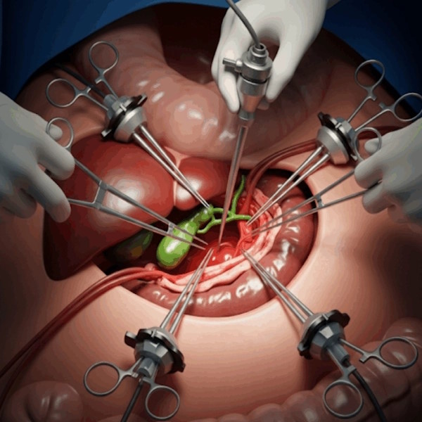 Cholecystectomy