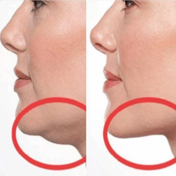 Double Chin Liposuction and Lift