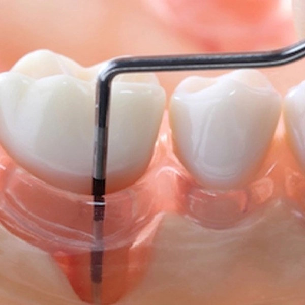 Gum-Treatment-or-Periodontal-Treatment