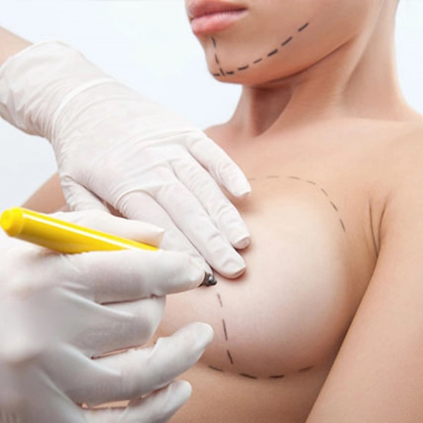 Mammoplasty