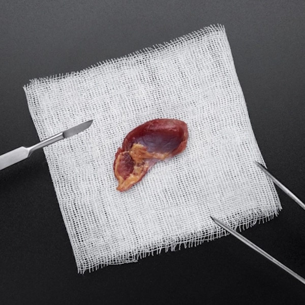 Polyps-and-Cysts-Removal