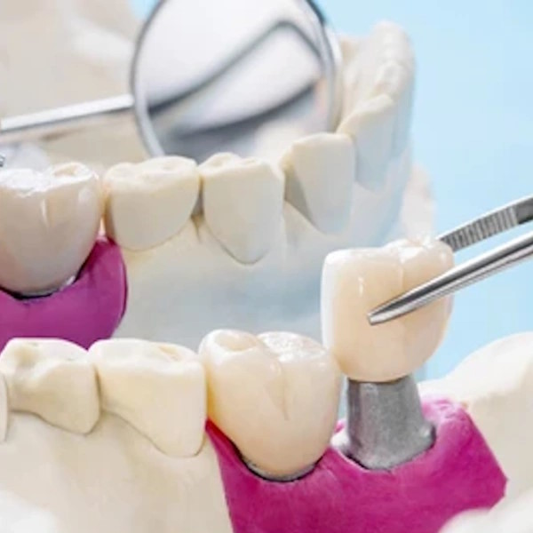 Prosthetic-Restoration-on-Implants