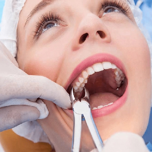 Tooth-Extraction